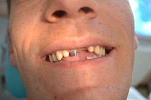 До протезирования передних зубов
