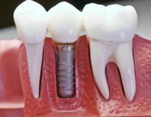 имплантация-зубов-Сумы