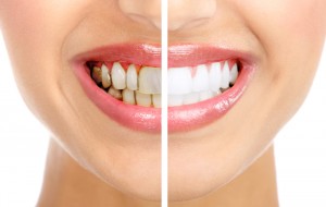 Зубной камень в стоматологии как опасность