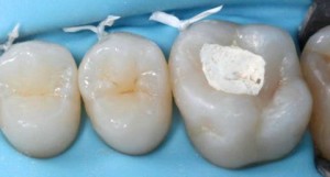 Зубные пломбы в стоматологии