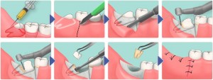 Симптомы и признаки прорезывания зубов мудрости