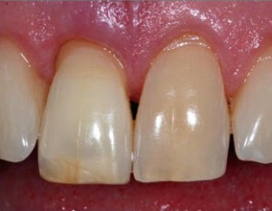 Эндоотбеливание в стоматологии