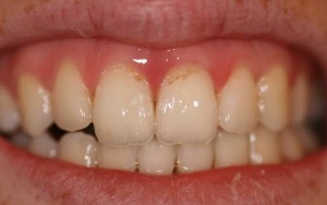 Причины и симптомы эрозии зубов