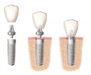 Какие виды абатментов в стоматологии бывают?