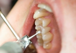 Препарирование (обточка) зубов