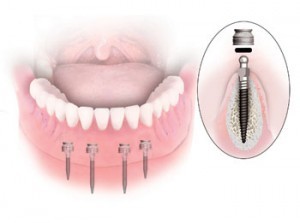 Мини-импланты в стоматологии