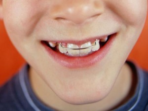Пластинки на зубы детям