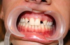 Убрать диастемы и тремы между зубами