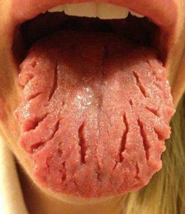 Трещины на языке в стоматологии