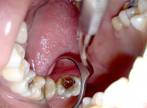Удаление зубного нерва