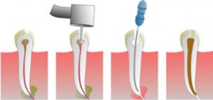 Показания для удаления зубного нерва и срок службы зуба
