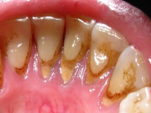 Причины возникновения и последствия зубного камня