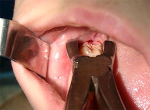 Осложнения прорезывания зубов мудрости
