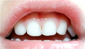 кариес передних зубов