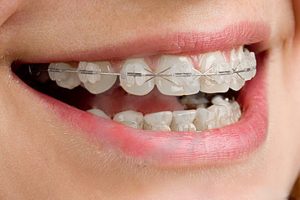 Почему нужно ровнять зубы