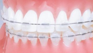 Эстетическая керамика в стоматологии