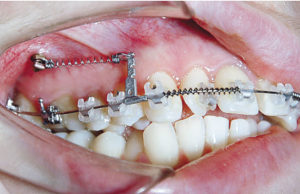 Применение винтов в практике ортодонта