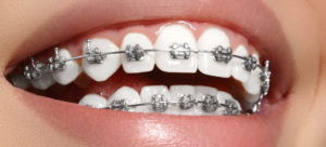 Что необходимо перед ортодонтическим лечением?
