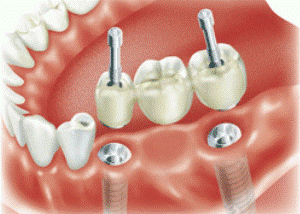 Про виды зубных протезов
