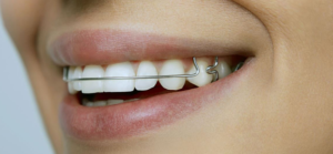 Какие пластинки на зубы бывают?